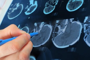 The Causes of a Traumatic Brain Injury