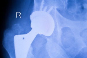 Stryker Issues Voluntary Recall Due To Defective Parts In Metal Hip Implant Devices