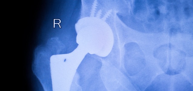 Stryker Issues Voluntary Recall Due To Defective Parts In Metal Hip Implant Devices