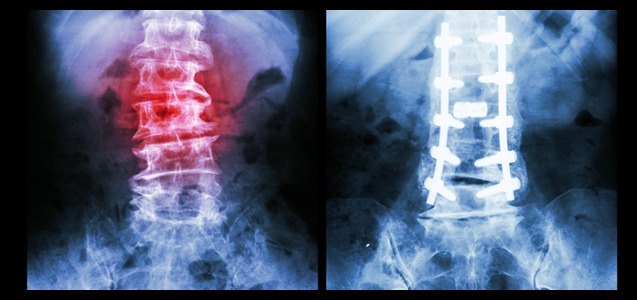 Paralysis Caused By Spinal Surgery