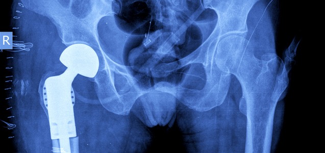 Diagnosing Hip Implant Pseudotumors with MARS MRI