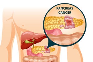 Signs and Symptoms of Pancreatic Cancer