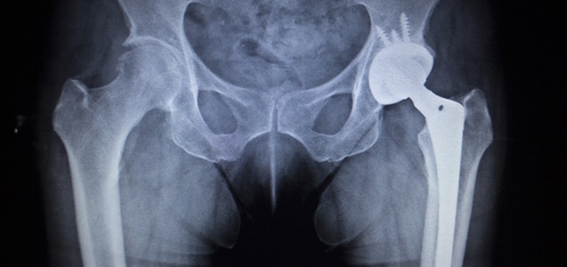 History Repeats Itself: MDL Created for another Defective Zimmer Metal on Metal Hip Replacement