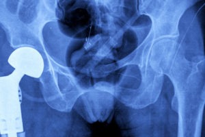 Defective Hip Implants Are Leading to Lawsuits