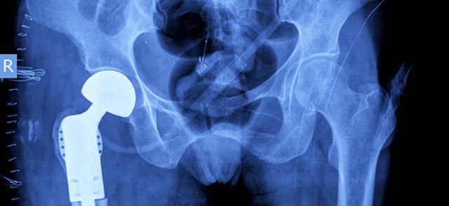 Defective Hip Implants Are Leading to Lawsuits