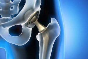 The First BHR Hip Resurfacing Case Is Scheduled for Trial
