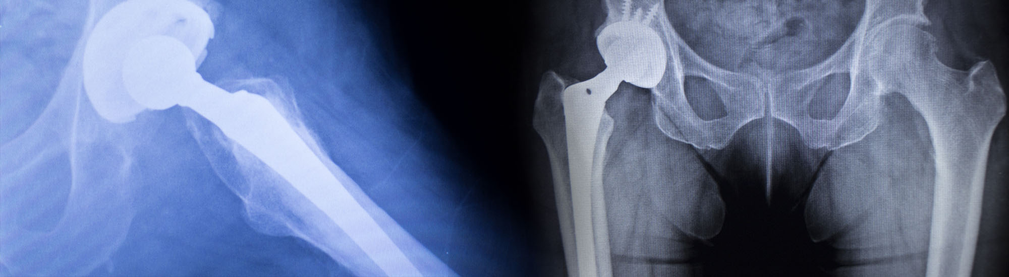 Hip Replacement Systems