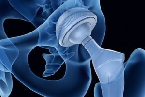 Exactech Offers Compensation for Faulty Hip—In Exchange for Your Legal Rights