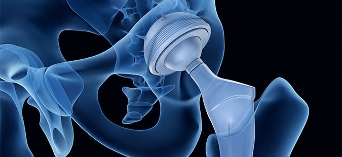 Exactech Offers Compensation for Faulty Hip—In Exchange for Your Legal Rights