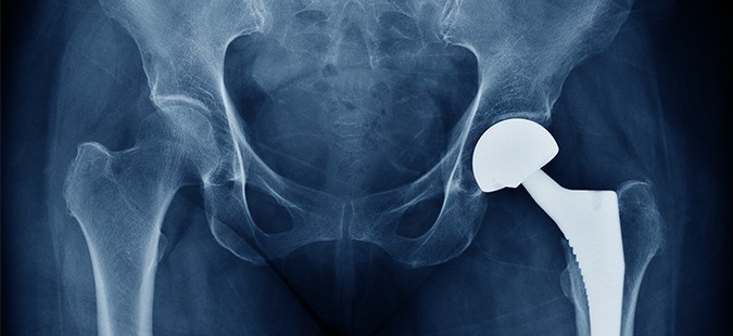 FDA Issues Recall on The Exactech Connexion GXL Hip Implant