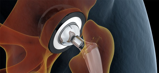 Exactech Faulty Liners Leaving 200,000+ Patients At Risk Of Implant Failure