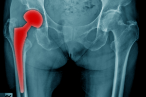 FDA Updates Exactech Hip Implant Recall