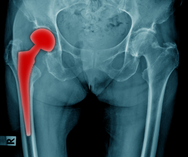 FDA Updates Exactech Hip Implant Recall