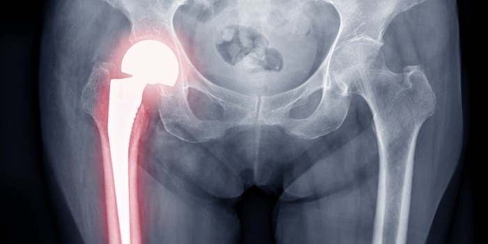 hip revision surgery after a defective exctech recall lawsuit