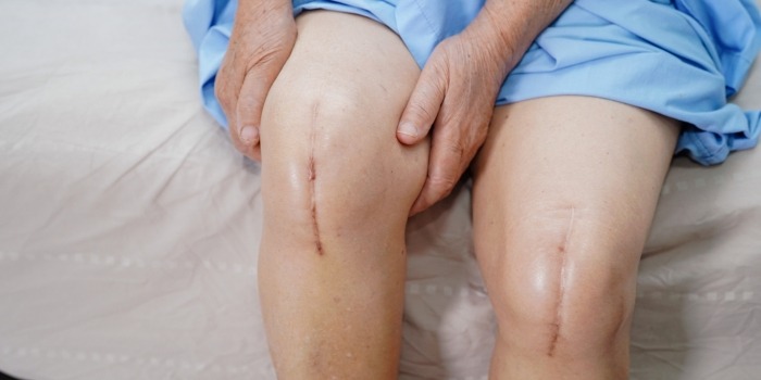 knee revision surgery after a defective exactech medical device