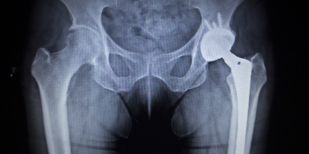 hip replacement surgery recall