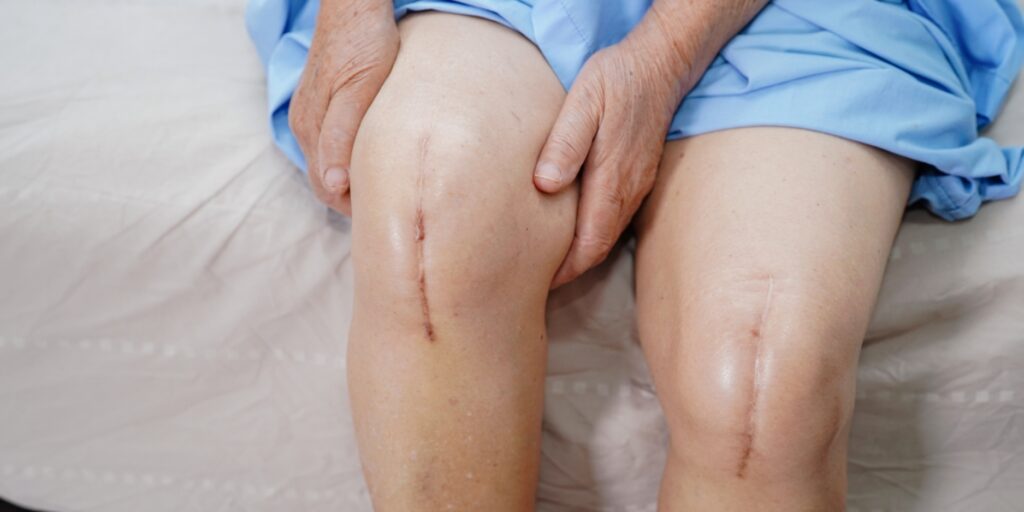 Patient required a revision knee replacement surgery