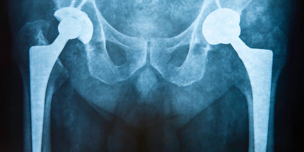 hip replacement surgery causing thigh bone fracture